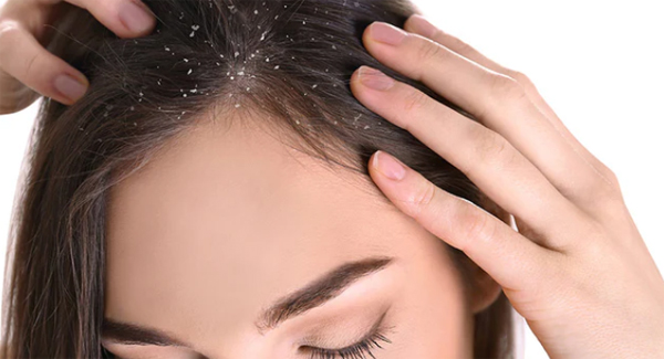 dandruff Treatment