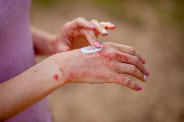 Eczema Treatment